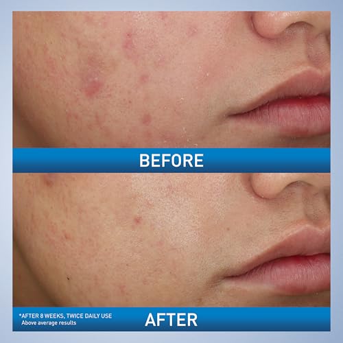 CeraVe - Crema espumosa para el acné, limpiador suave para rostro y cuerpo con peróxido de benzoilo al 10%, ácido hialurónico y niacinamida, tratamiento con peróxido de benzoilo al 10% que elimina granos y puntos negros. 5 Oz